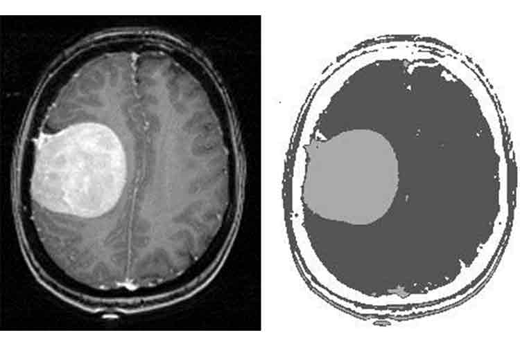 برنامه متلب طبقه بندی تصاویر MRI با فازی سی مینز (FCM)