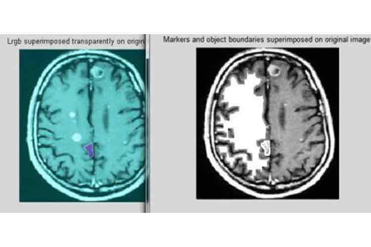 برنامه‌های متلب تشخص تومور مغزی با استفاده از پردازش تصویر