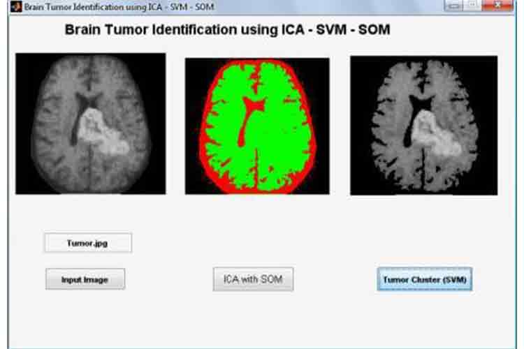 برنامه متلب (matlab) تشخیص تومور در مغز با استفاده از ICA و SOM ،SVM